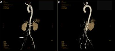 Acute limb ischemia caused by floating thrombus in the aorta: a case report and literature review